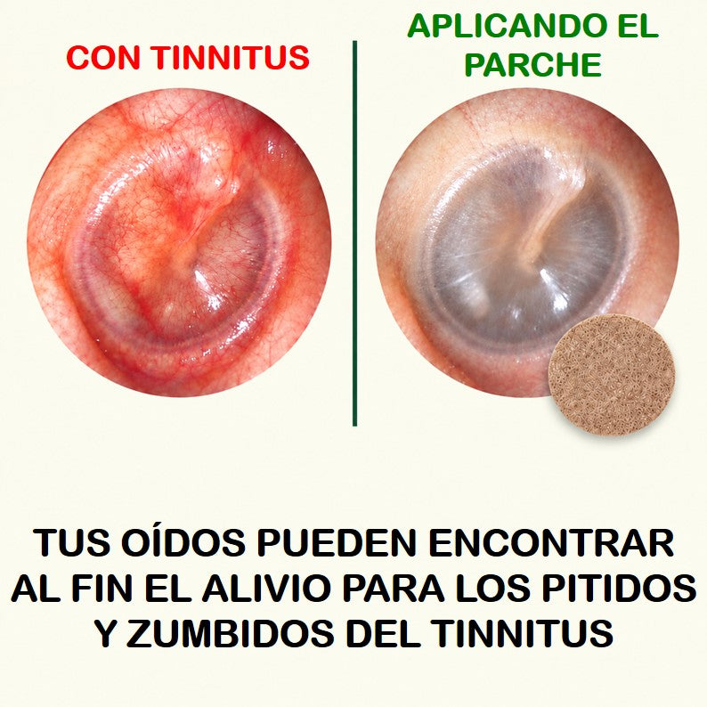 Parches de Alivio de Tinnius